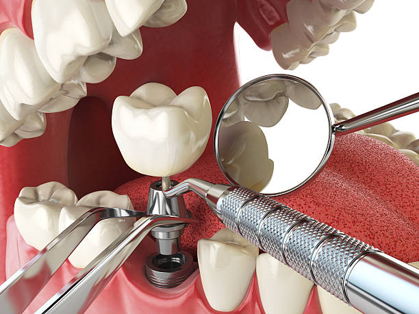 Best Emergency Dental Care for Abscessed Tooth in Rochelle, GA